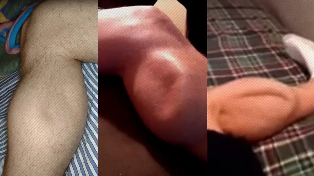 Calf Cramp