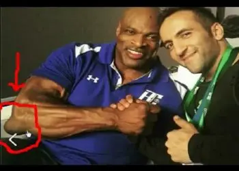 WATCH: What Causes Bodybuilder’s Abnormal Elbow Growth?