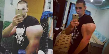 Russian Teen Shows Insane Amount Of Synthol In His Arms