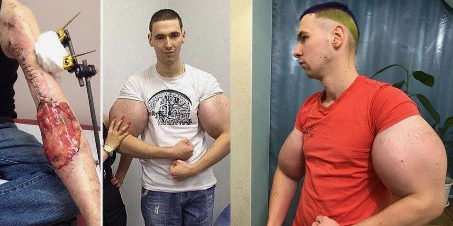 Russian Synthol Kid Has Oil Removal Surgery 