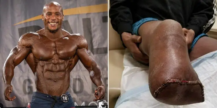 IFBB Pro Shawn Labega Goes Under Leg Amputation