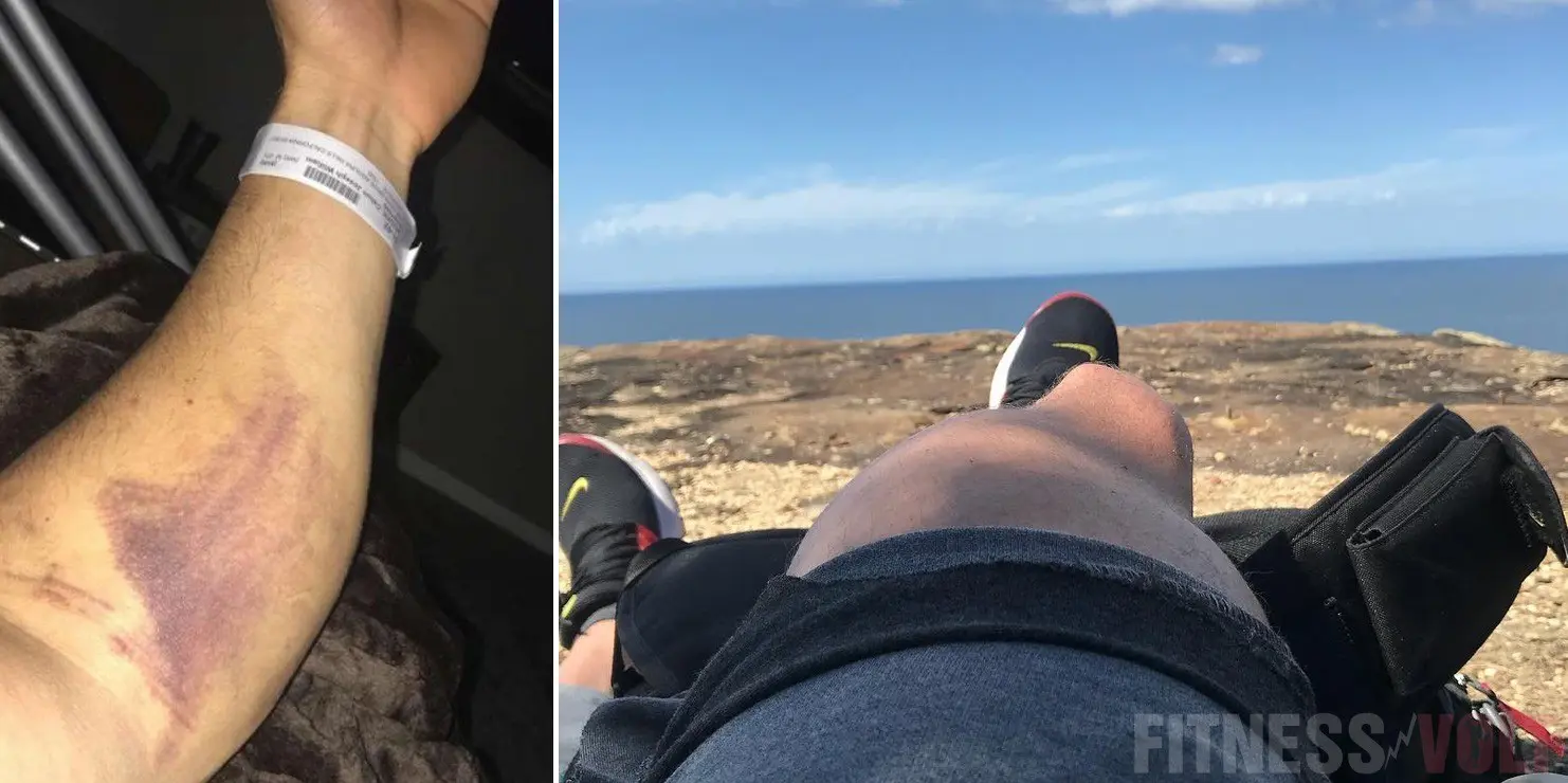 Calum Von Moger Injured