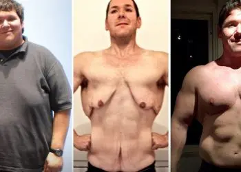 Loose Skin After Weight Loss