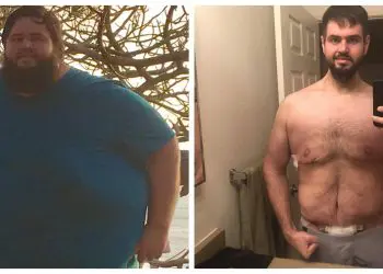 Man Loses 300 lbs, Has To Have Surgery To Remove 13 lbs Of Extra Skin!
