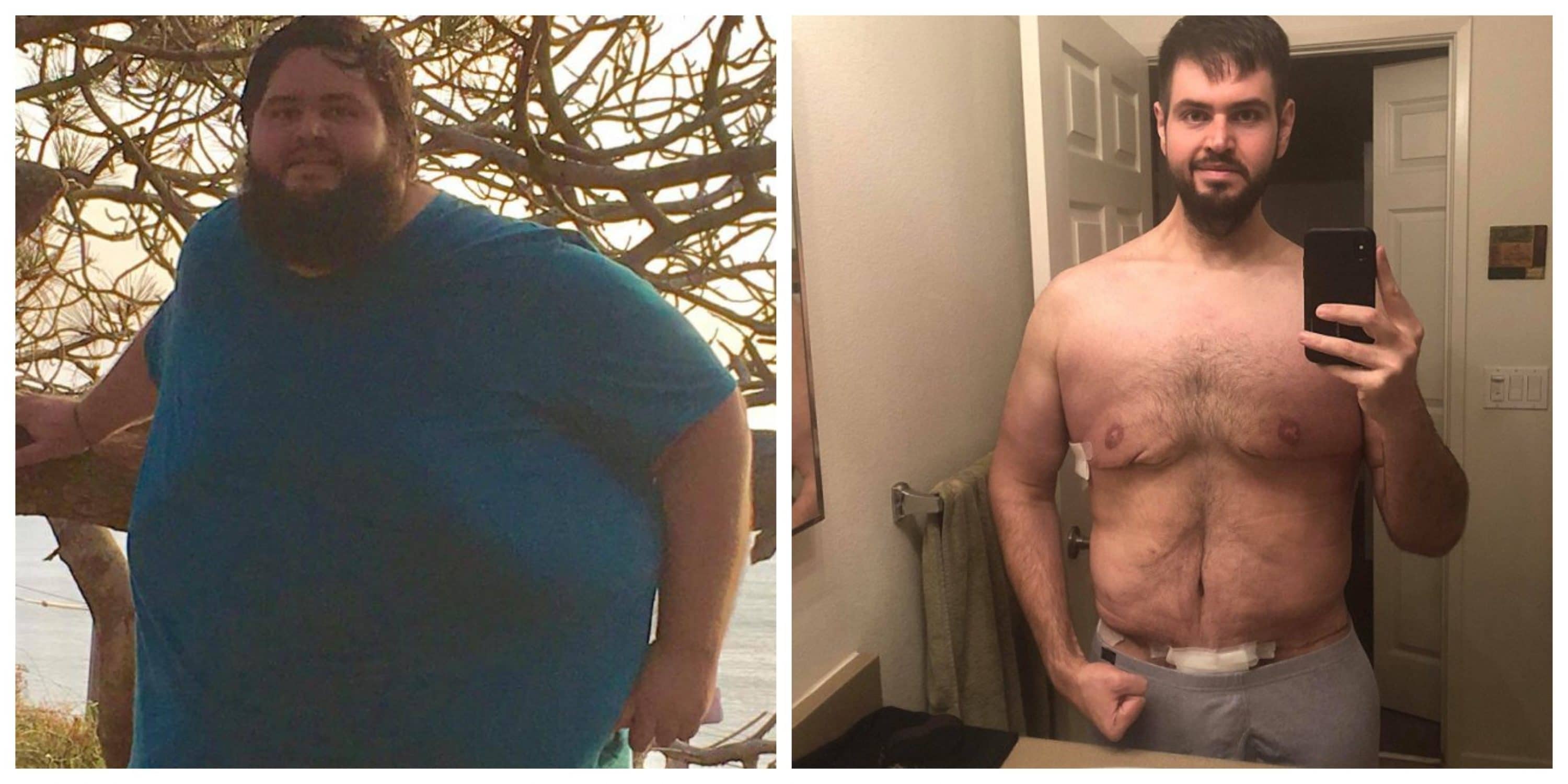 Man Loses 300 lbs, Has To Have Surgery To Remove 13 lbs Of Extra Skin! 