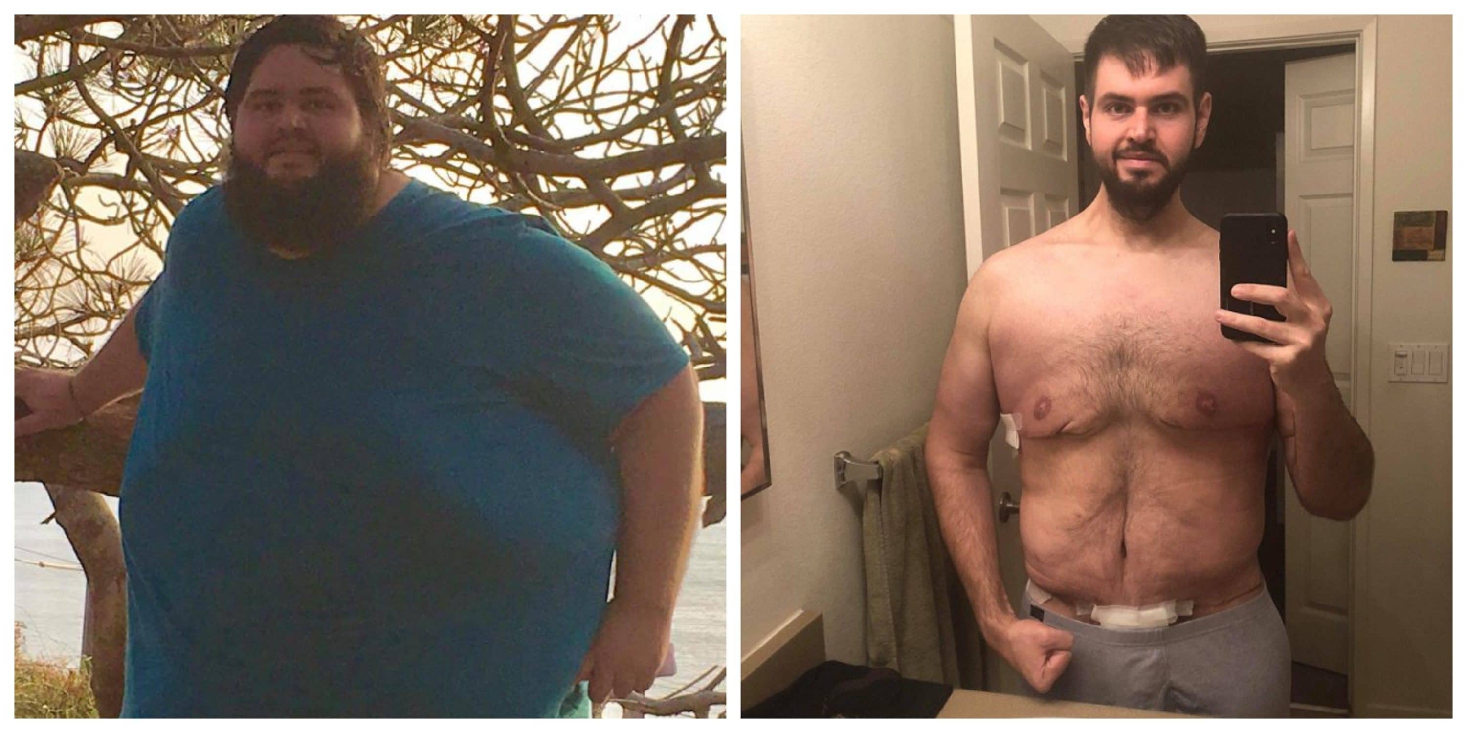 man-loses-300-lbs-has-to-have-surgery-to-remove-13-lbs-of-extra-skin