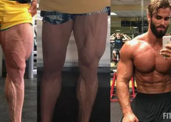 Calum von Moger Surgery
