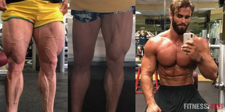 Calum von Moger Surgery