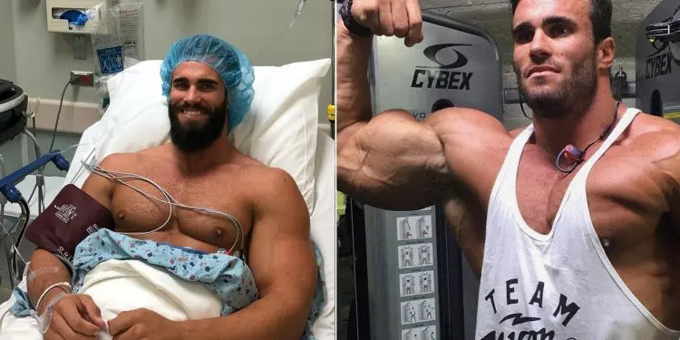 Calum Von Moger Once Again Undergoing Bicep Surgery