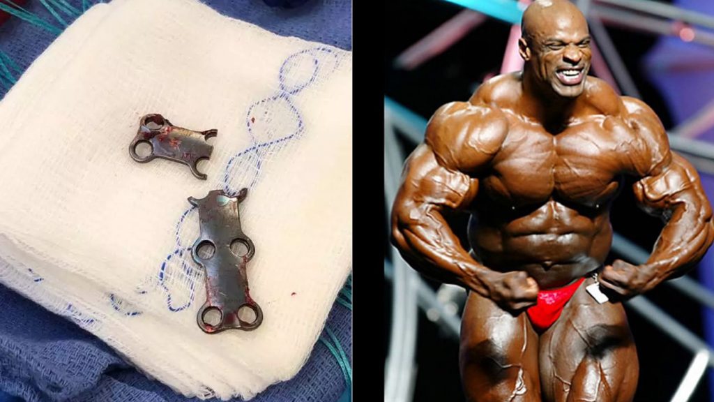 Ronnie Coleman Shares Scary Details Of Most Recent Surgery