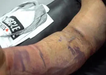 Antoine Vaillant Bicep Tear