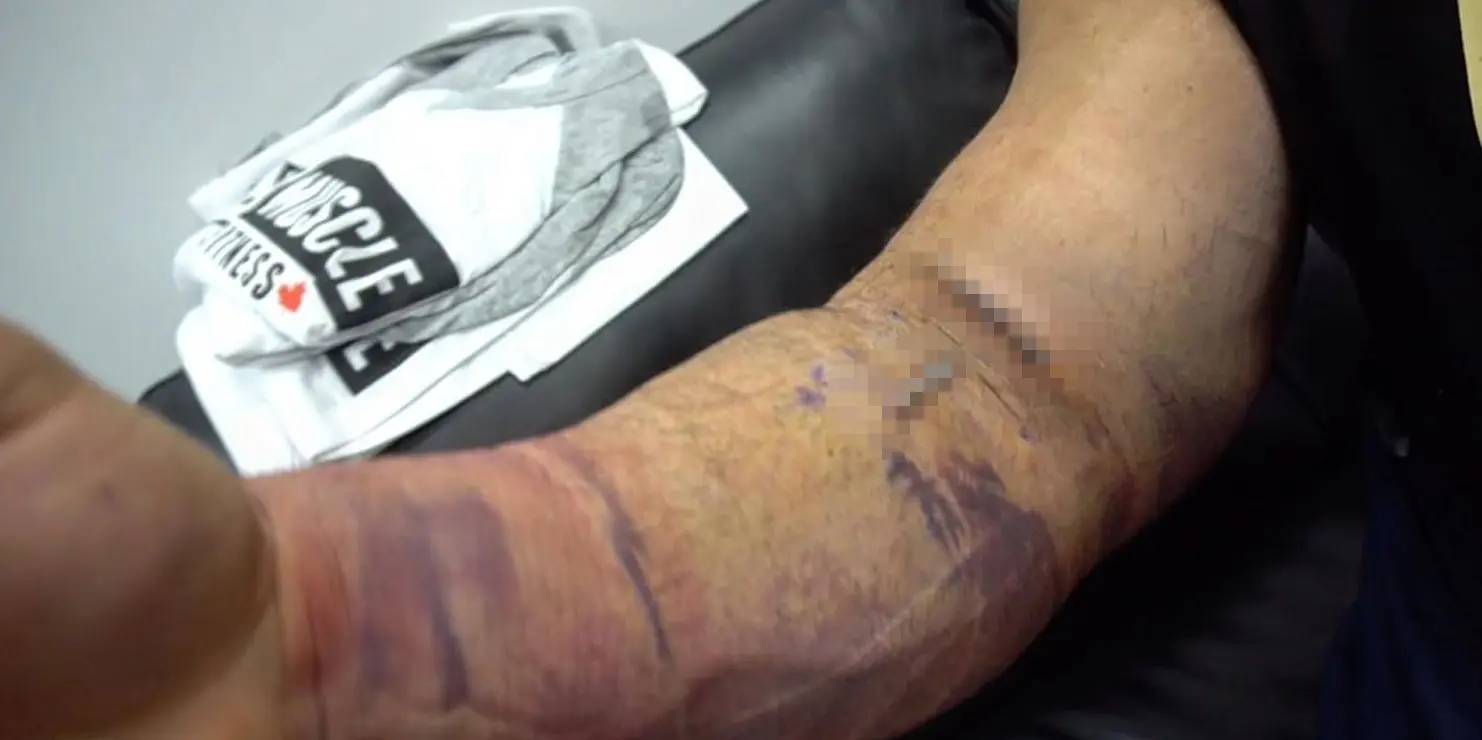 Antoine Vaillant Bicep Tear