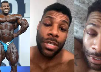 Nathan De Asha Eye Infection