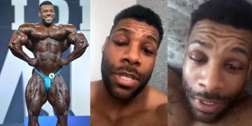 Nathan De Asha Eye Infection