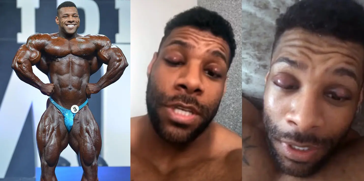 Nathan De Asha Eye Infection