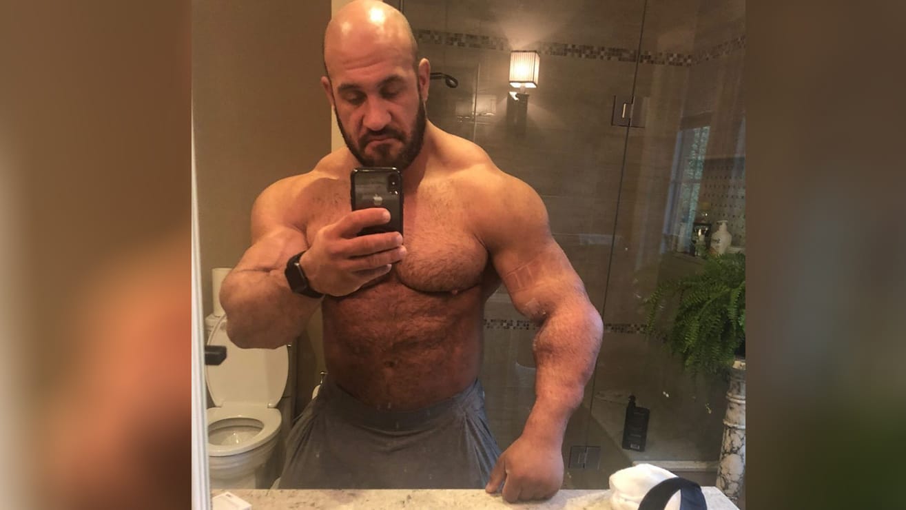 Antoine Vaillant Shares Post Bicep Surgery Photos Graphic Images, Photos, Reviews
