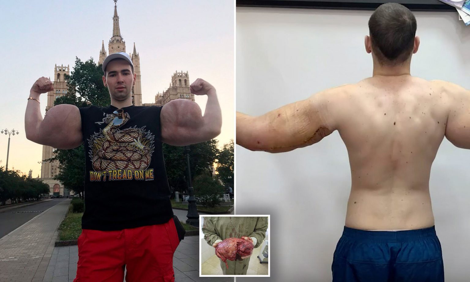 UPDATED Russian Synthol Freak Ruki Bazuki Undergoes Biceps Surgery 