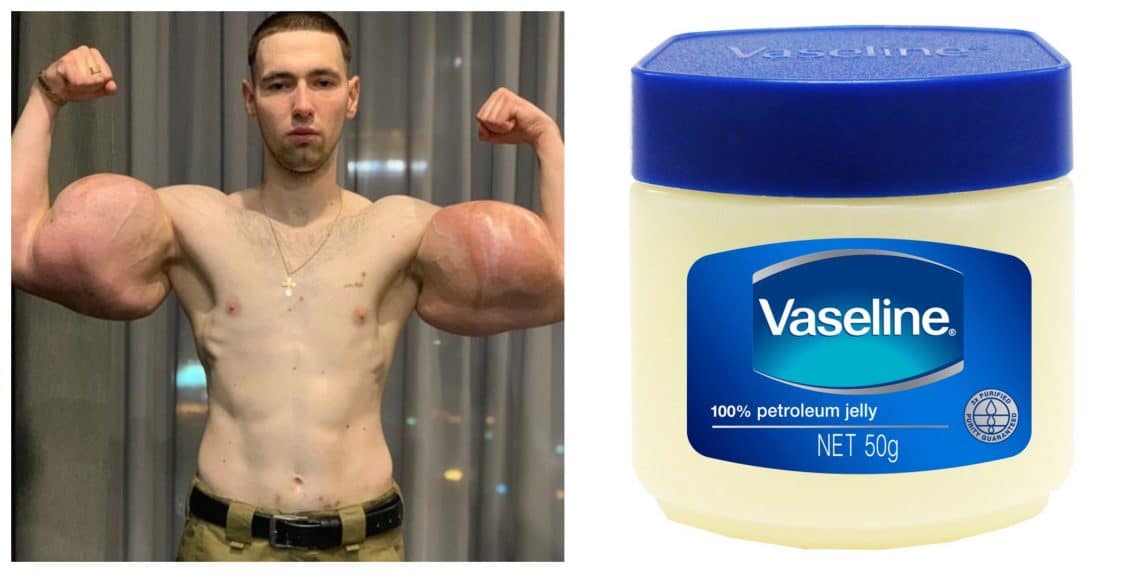 UPDATED: Russian Synthol Freak "Ruki Bazuki" Undergoes Biceps Surgery