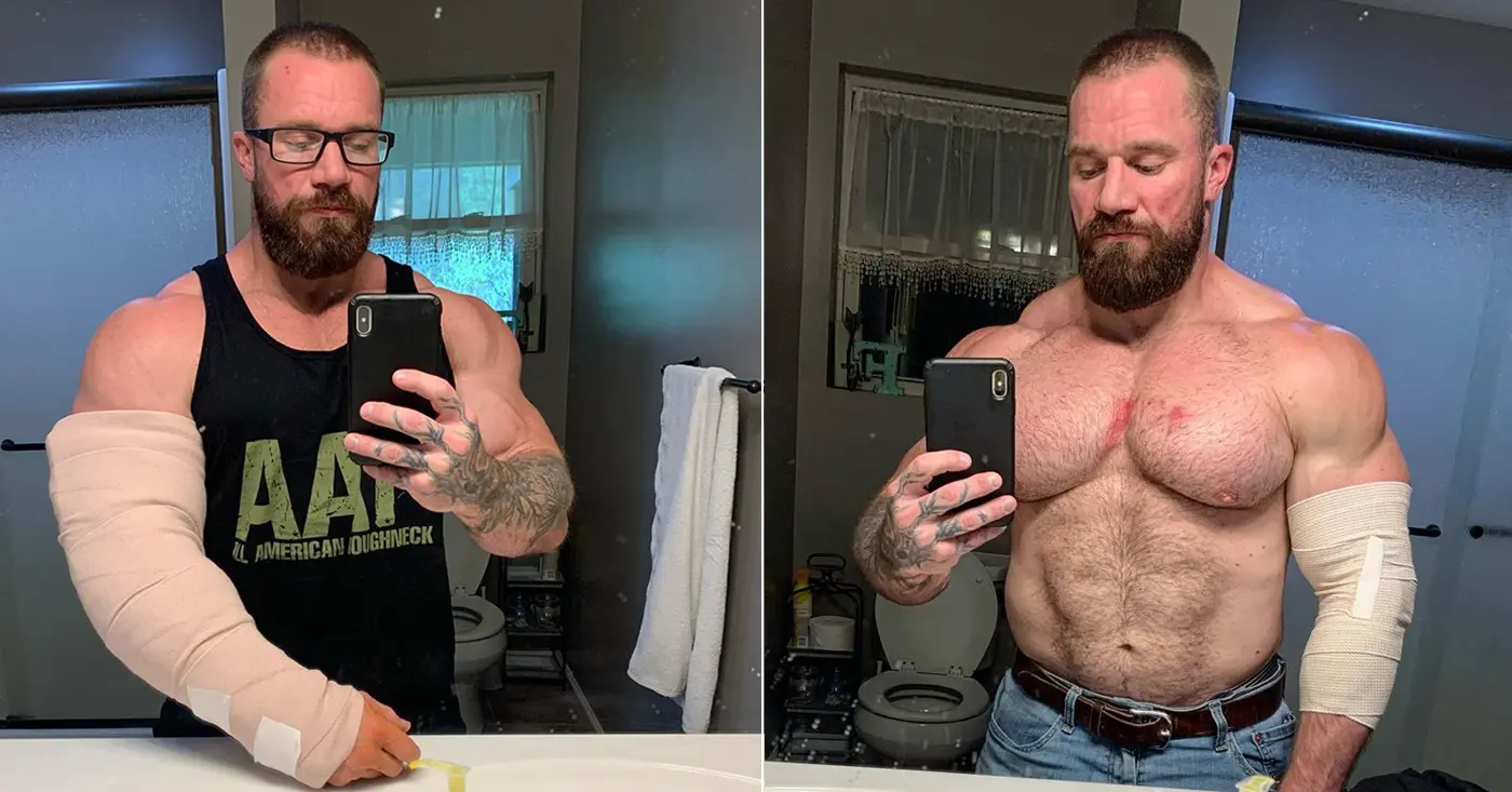 Seth Feroce Tears Triceps