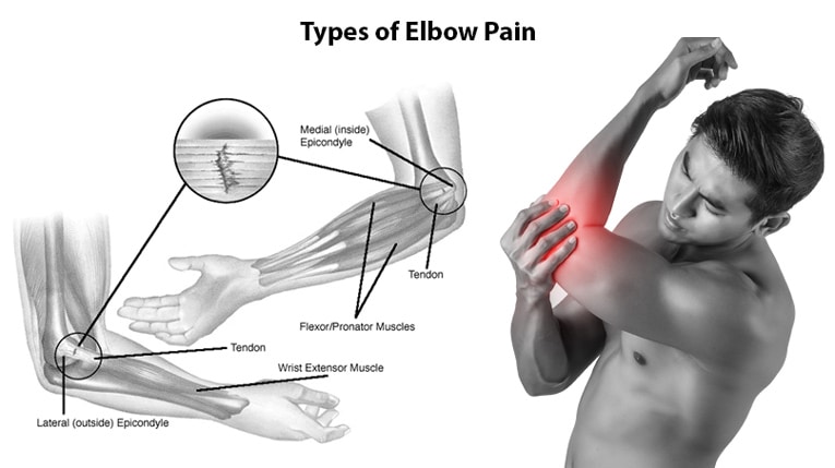 Types of Elbow Pain