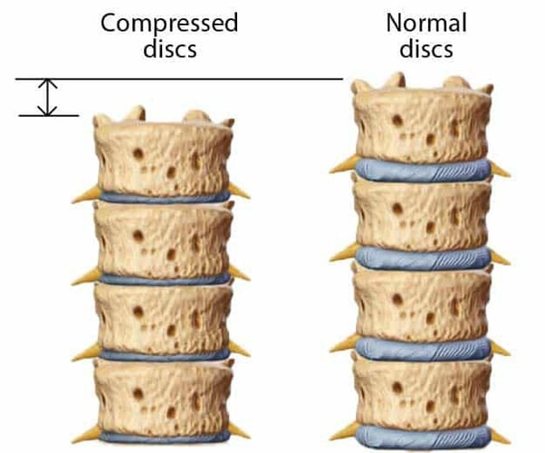 Spinal decompression