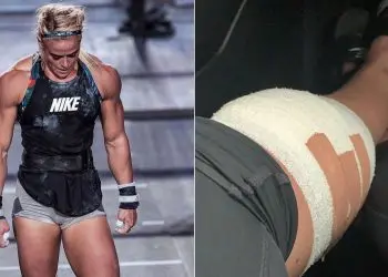 Sara Sigmundsdottir Ruptures ACL