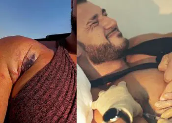 Ryan Crowley Pec Tear Again Stem Cell