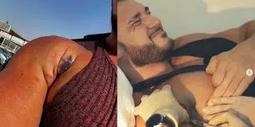 Ryan Crowley Pec Tear Again Stem Cell