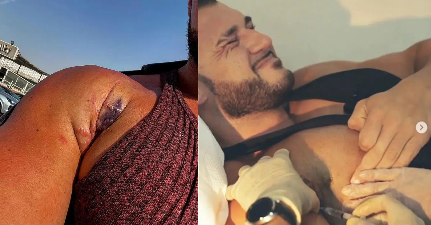 Ryan Crowley Pec Tear Again Stem Cell