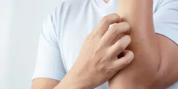 Why Does Pre Workout Make You Itch