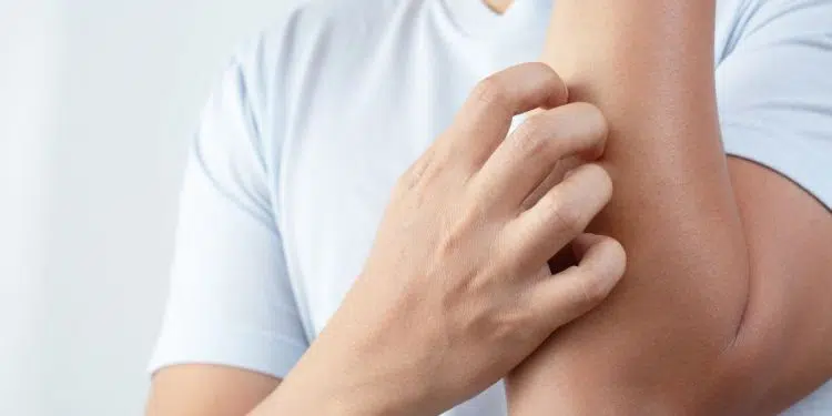 Why Does Pre Workout Make You Itch