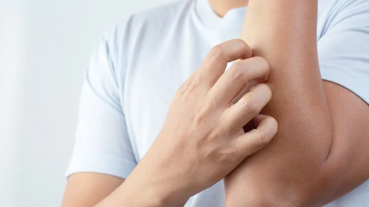 Why Does Pre Workout Make You Itch