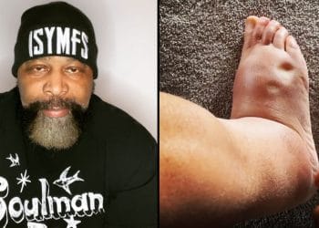 Ct Fletcher Anti Rejection Medication