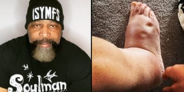 Ct Fletcher Anti Rejection Medication