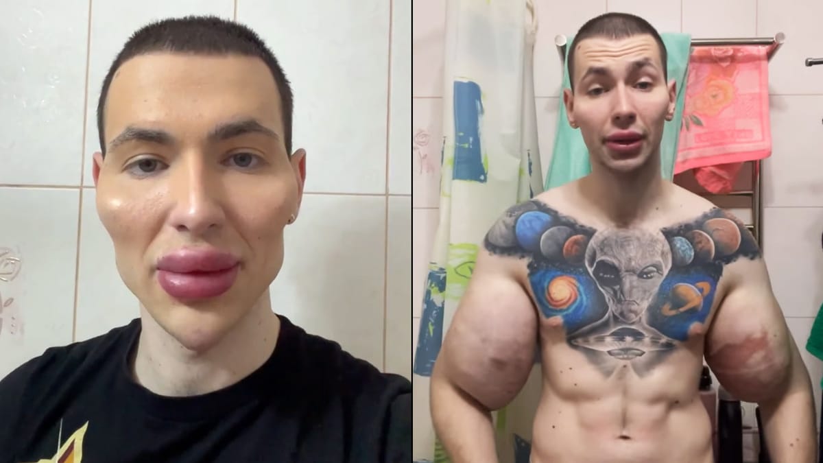 Video: 'The Synthol Kid' Gets 'Alien' Injections in Face, Refusing Doctor  Recommendations – Fitness Volt