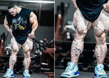 Nick Walker Shows Huge Varicose Veins