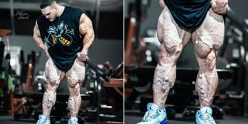 Nick Walker Shows Huge Varicose Veins