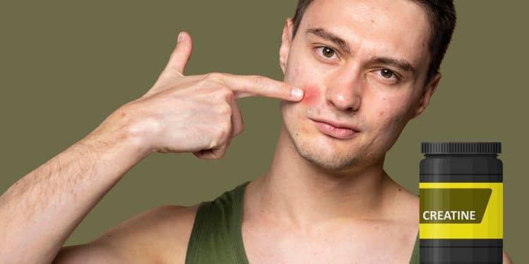 Does Creatine Cause Acne