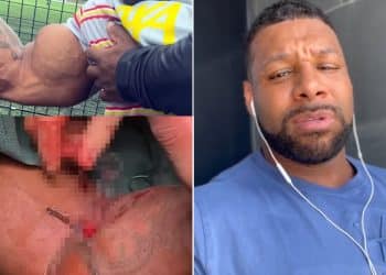 Nathan De Asha Bicep Tears