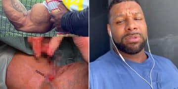 Nathan De Asha Bicep Tears