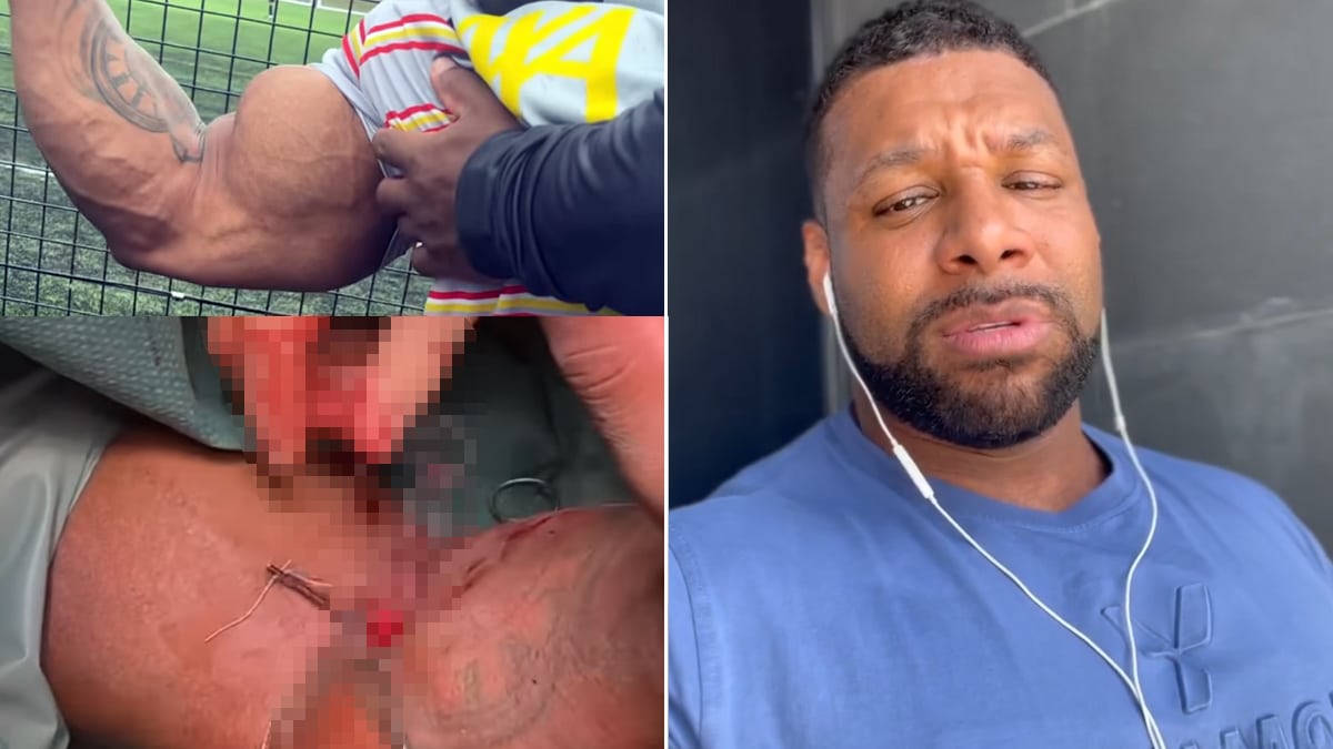 Nathan De Asha Bicep Tears