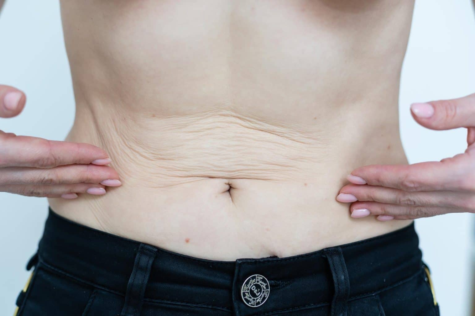 How To Differentiate Between Loose Skin Vs Fat The Ultimate Guide