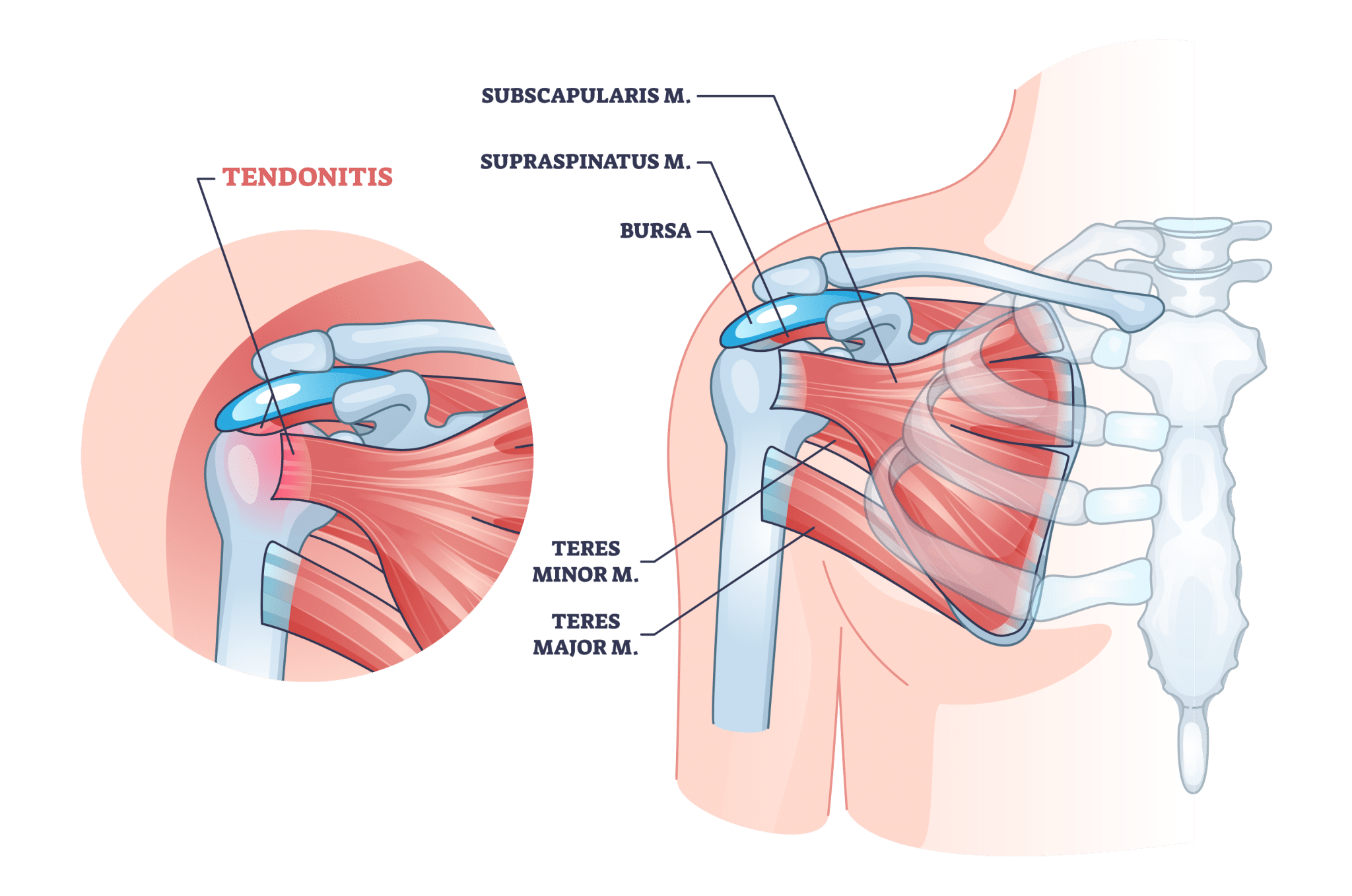 Shoulder Tendonitis Symptoms Causes Treatment And Prevention   Shoulder Tendonitis 2048x1357 