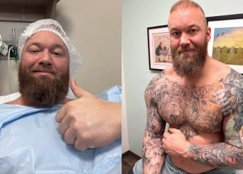 Hafthor Bjornsson Pec Tear Surgery
