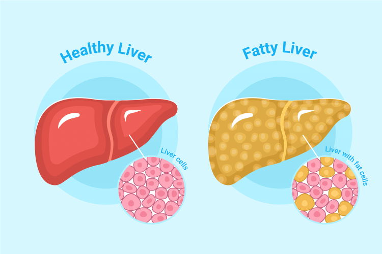 Healthy Vs Fatty Liver