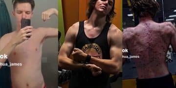 Tiktoker Severe Back Acne