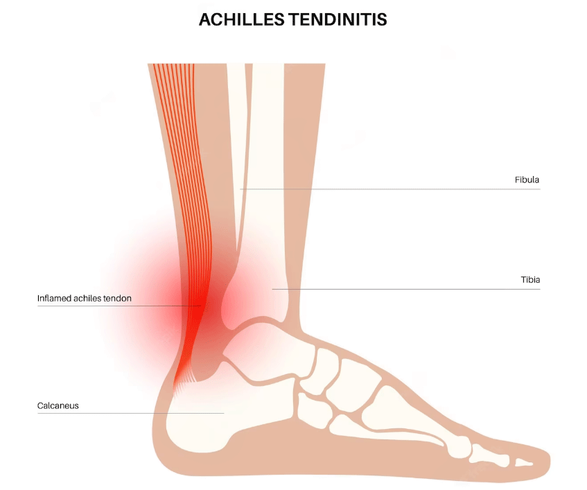 Common Bodybuilding Injuries and How to Avoid Them – Fitness Volt