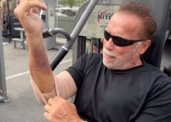 Arnold Schwarzenegger Pump Post Surgery