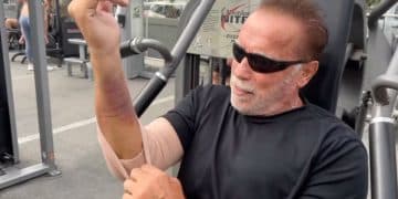 Arnold Schwarzenegger Pump Post Surgery