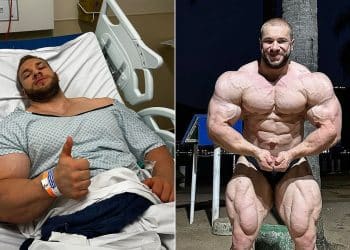 Good Vito Hernia Surgery